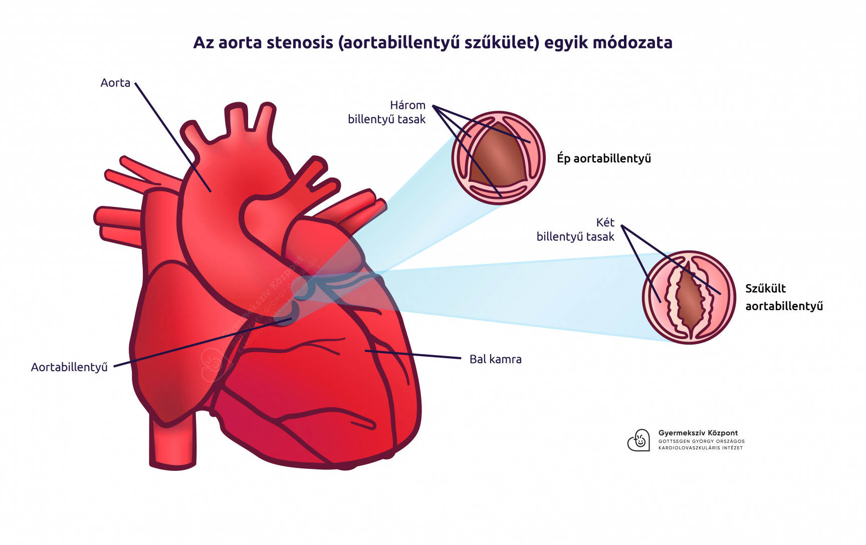 súlycsökkenés és aorta szűkület)