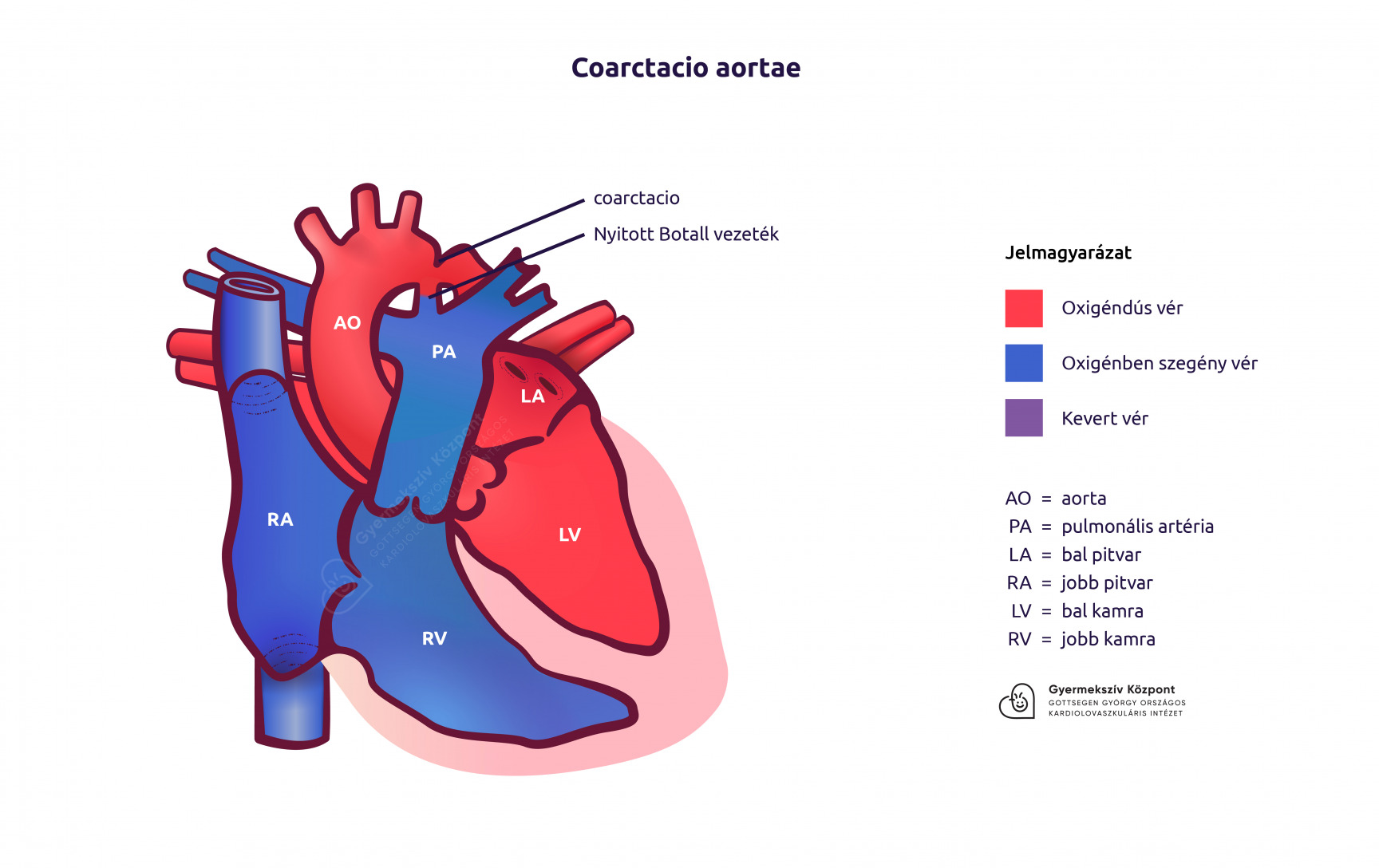 a magas vérnyomás aorta kezelésének koarktációja)