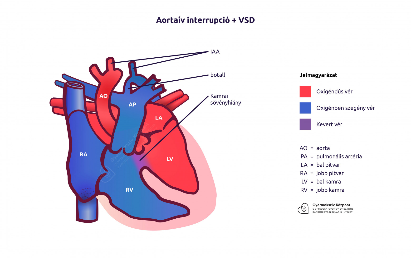 Aortaív interrupció + VSD rajz