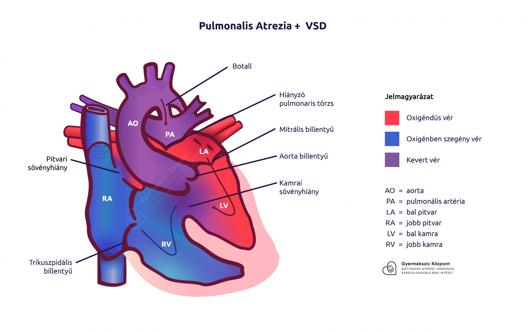 Pulmonalis atrezia + VSD
